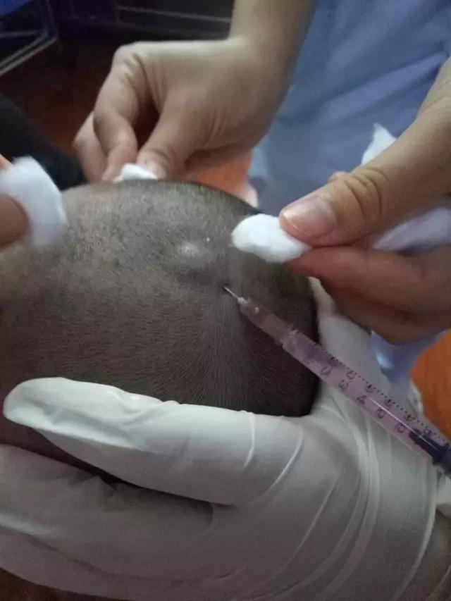 小兒腦癱之穴位注射療法主的效果及治療范圍
